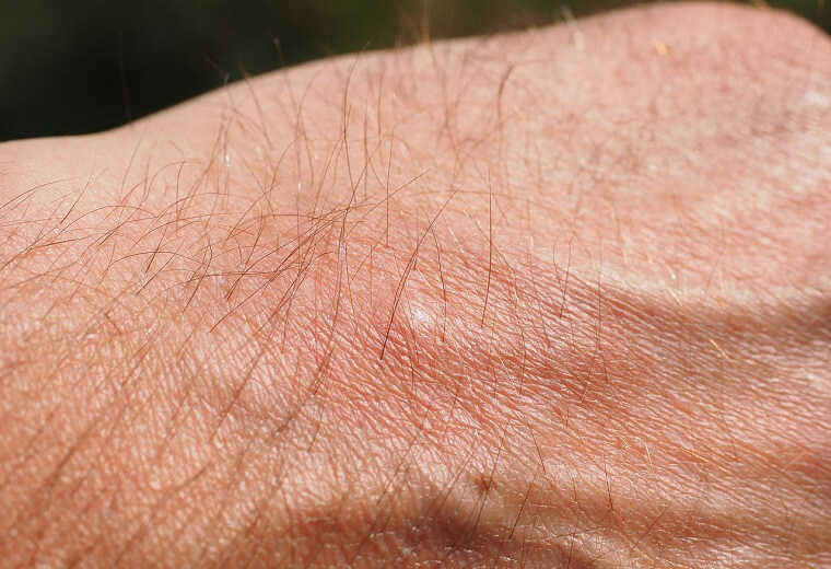 Mückenstich Hand