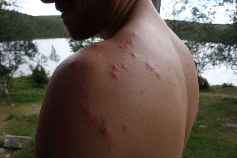 Mückenstich narben behandeln